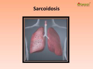 Sarcoidosis: Causes, Symptoms, Daignosis, Prevention and Treatment
