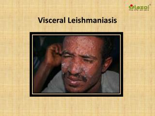 Visceral Leishmaniasis: Causes, Symptoms, Daignosis, Prevention and Treatment