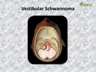 Vestibular Schwannoma: Causes, Symptoms, Daignosis, Prevention and Treatment
