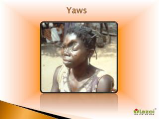 Yaws: Causes, Symptoms, Daignosis, Prevention and Treatment