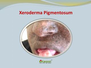 Xeroderma Pigmentosum: Causes, Symptoms, Daignosis, Prevention and Treatment
