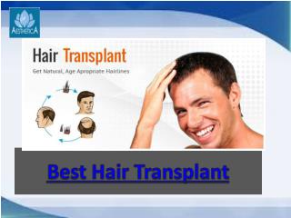 Best Hair Transplant