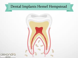 Dental Implants Hemel Hempstead