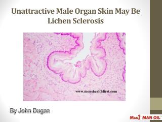 Unattractive Male Organ Skin May Be Lichen Sclerosis