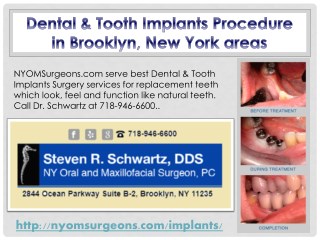 Dental & Tooth Implants Procedure in Brooklyn, New York areas - NYOMSurgeons.com