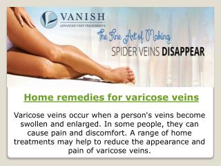 Home remedies for varicose veins