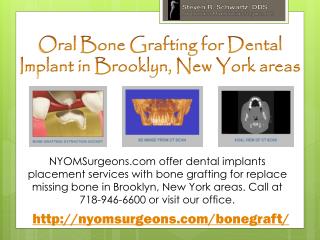 Oral Bone Grafting for Dental Implant in Brooklyn, New York areas - NYOMSurgeons.com