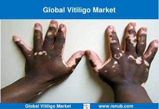 Global Vitiligo Market Forecast