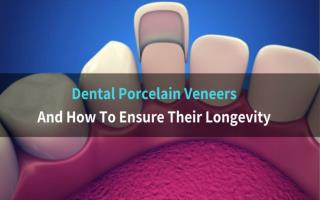 Dental Porcelain Veneers And How To Ensure Their Longevity
