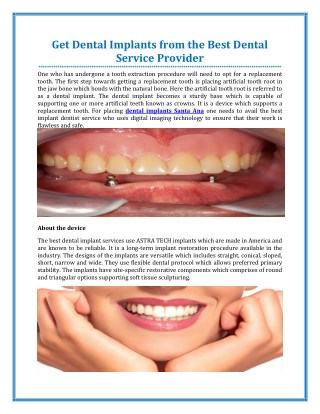 Get Dental Implants from the Best Dental Service Provider