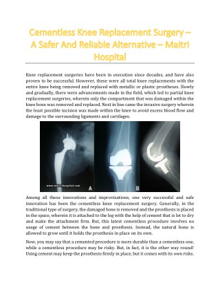 Cementless Knee Replacement Surgery – A Safer And Reliable Alternative - Maitri Hospital