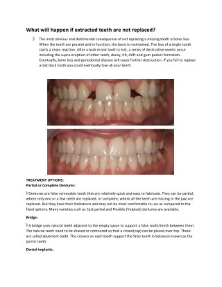 Replacement of Missing Teeth