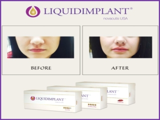 High Quality Hyaluronic Acid Filler Gel