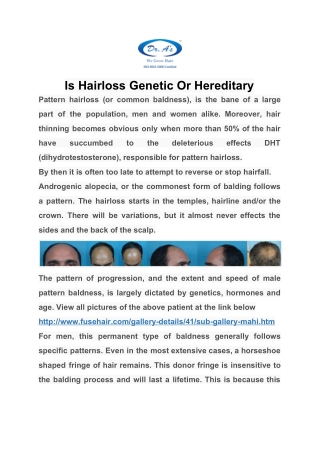 Is Hairloss Genetic Or Hereditary