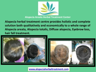 Alopecia Areata Herbal Treatment