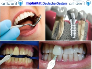 Implantat deutsche osstem