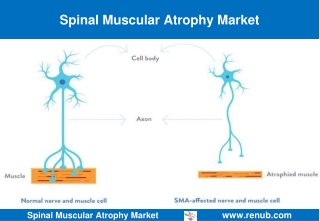 Spinal Muscular Atrophy Market Size