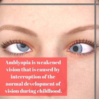 A problem of Lazy eye : Amblyopia