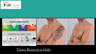 Tattoo Removal in Delhi