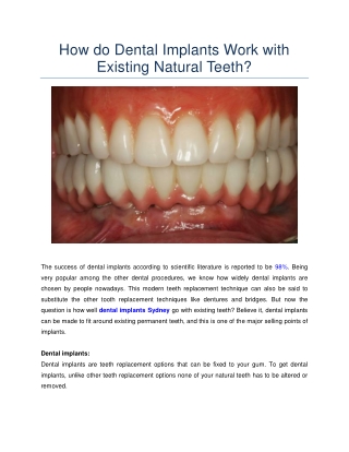 How do Dental Implants Work with Existing Natural Teeth?