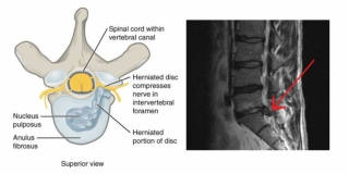 Back pain treatment in Coimbatore - One Care Medical Center