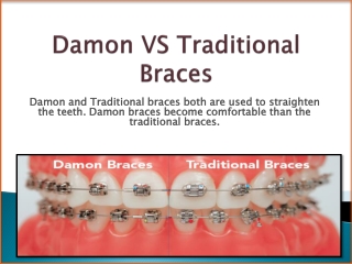 Reasons Why Damon Braces are Differing to The Traditional Braces