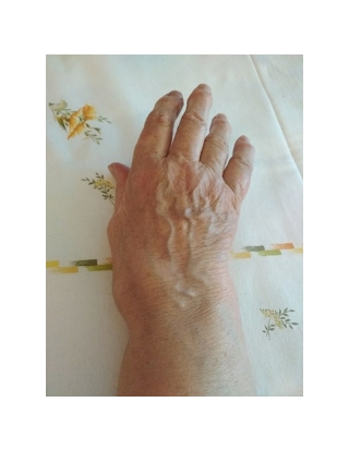 Arthritis treatment in Coimbatore