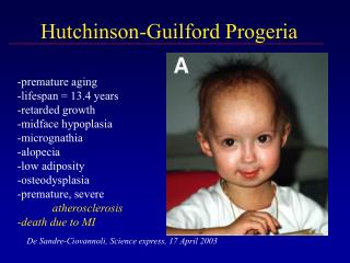 Hutchinson-Guilford Progeria