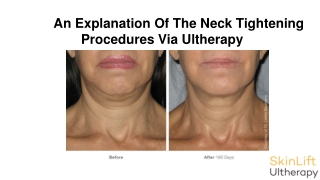 An Explanation Of The Neck Tightening Procedures Via Ultherapy