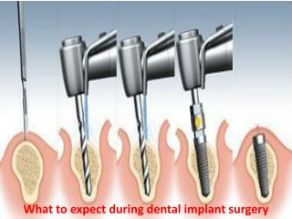 What to expect during dental implant surgery