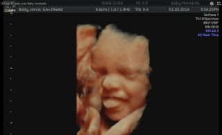 Pregnancy scan at Newbury
