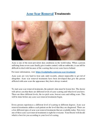 Acne Scar Removal Treatments