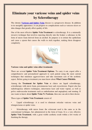 Eliminate your varicose veins and spider veins by Sclerotherapy