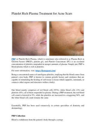 Platelet Rich Plasma Treatment for Acne Scars