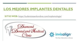 Los mejores Implantes Dentales | Tudentisitaenlondres.com
