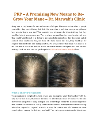 PRP – A Promising New Means To Re-Grow Your Mane - Dr. Marwah's Clinic