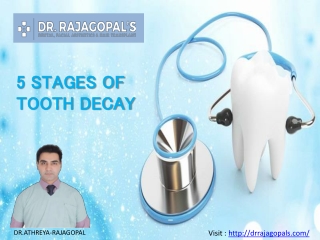 5 Stages of Tooth Decay - Dr. RajaGopal's Clinic.