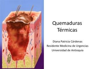 Quemaduras Térmicas