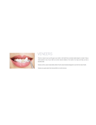 Veneers in Marine City