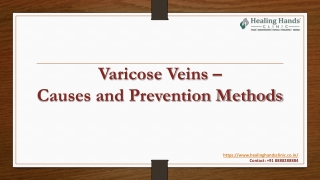 Varicose Veins – Causes and Prevention Methods
