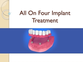 All On 4 Treatment | Rajan Dental