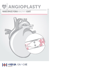 Angioplasty - Make space for a healthy heart