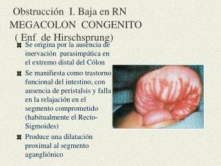 Obstrucción I. Baja en RN MEGACOLON CONGENITO ( Enf de Hirschsprung)