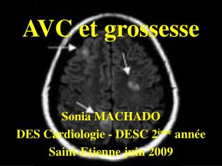 AVC et grossesse