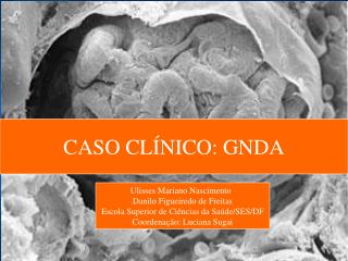 CASO CLÍNICO: GNDA