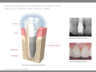 Single Tooth Loss