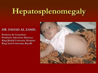 Hepatosplenomegaly