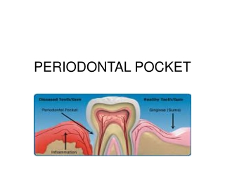 PERIODONTAL POCKET