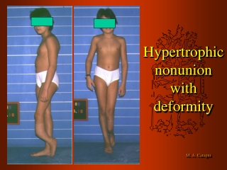 Hypertrophic nonunion with deformity