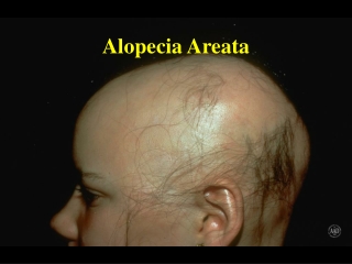 Alopecia Areata